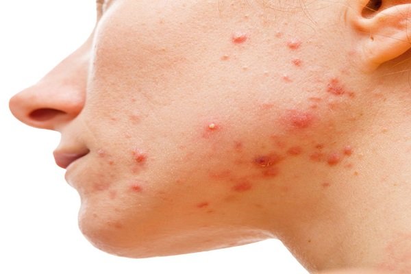 remedio acne no rosto tratamento manchas